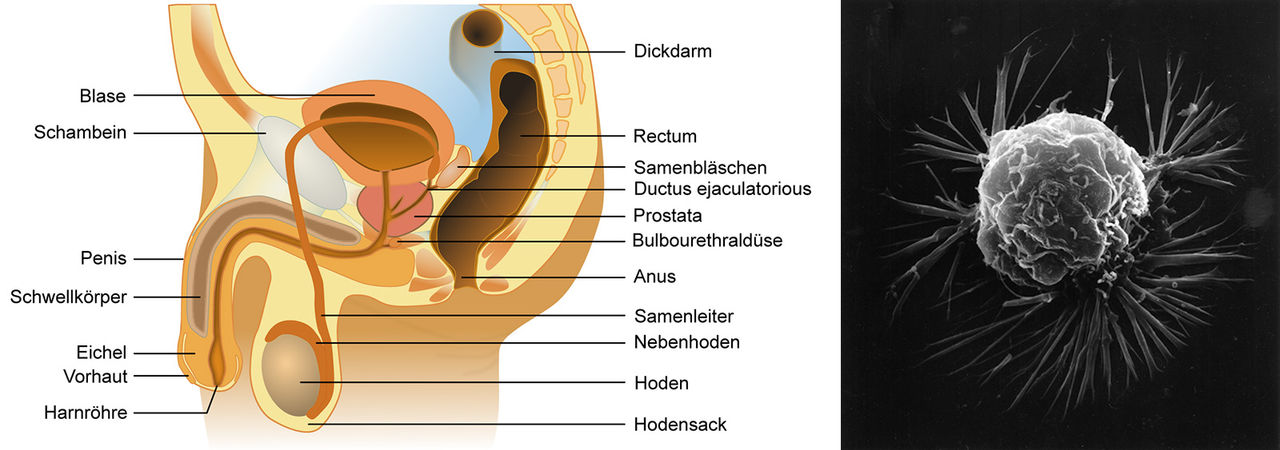 Anatomie der Prostata und Brustkrebszelle unter einem Mikroskop